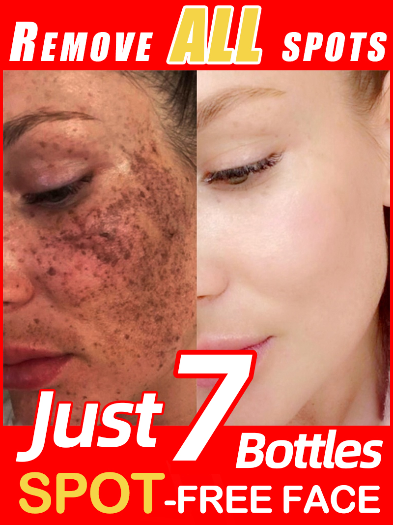 Lighten Freckles Melasma, Faci - đánh giá và giá Skincare Luxury Whitening